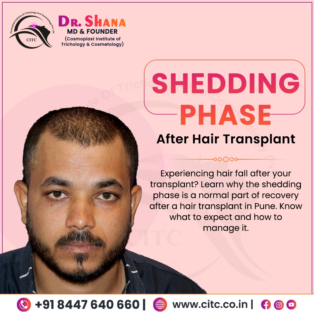 Shedding Phase After Hair Transplant in Pune